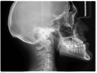 Röntgenbild eines menschlichen Schädels im Profil.